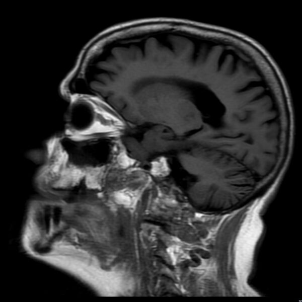 File:Cerebellar ataxia with neuropathy and vestibular areflexia syndrome (CANVAS) (Radiopaedia 74283-85159 Sagittal FLAIR 8).jpg