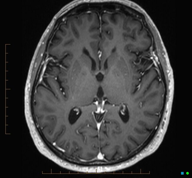File:Cerebellar gangliocytoma (Radiopaedia 65377-74422 Axial T1 C+ 66).jpg