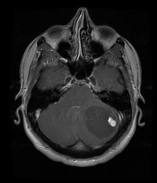File:Cerebellar hemangioblastoma (Radiopaedia 26611).jpg
