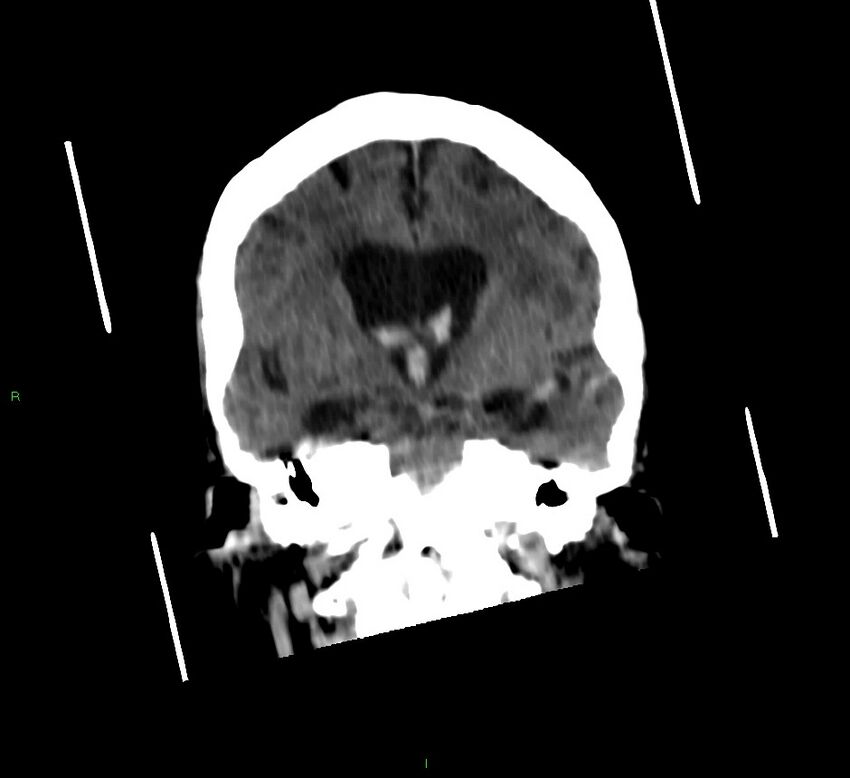 Cerebellar hemorrhage (Radiopaedia 58792-66026 Coronal non-contrast 36).jpg