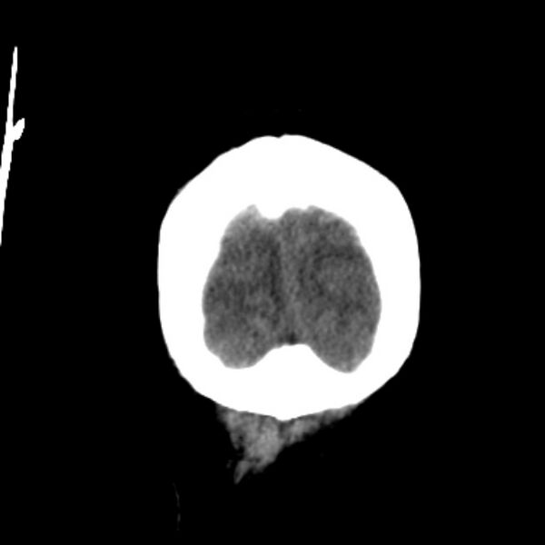File:Cerebellar hemorrhage causing obstructive hydrocephalus (Radiopaedia 33989-35207 Coronal non-contrast 51).jpg