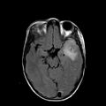 Cerebral abscess post cardiac surgery (Radiopaedia 27244-27420 Axial FLAIR 9).jpg