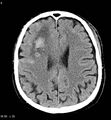 Cerebral abscesses secondary to contusions (Radiopaedia 5201-22213 Axial non-contrast 1).jpg