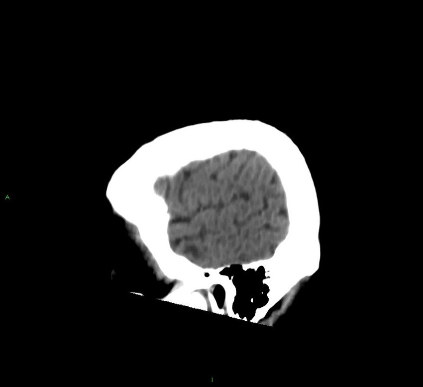 Cerebral amyloid angiopathy-associated lobar intracerebral hemorrhage (Radiopaedia 58376-65513 C 57).jpg