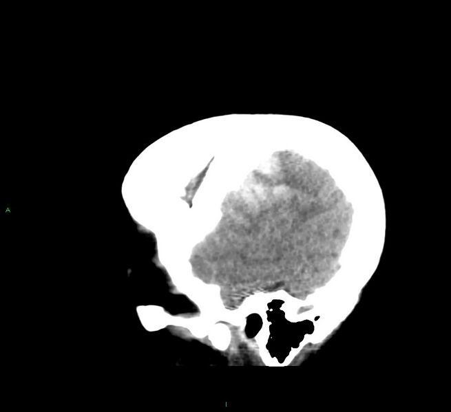 File:Cerebral amyloid angiopathy-associated lobar intracerebral hemorrhage (Radiopaedia 58379-65519 C 8).jpg
