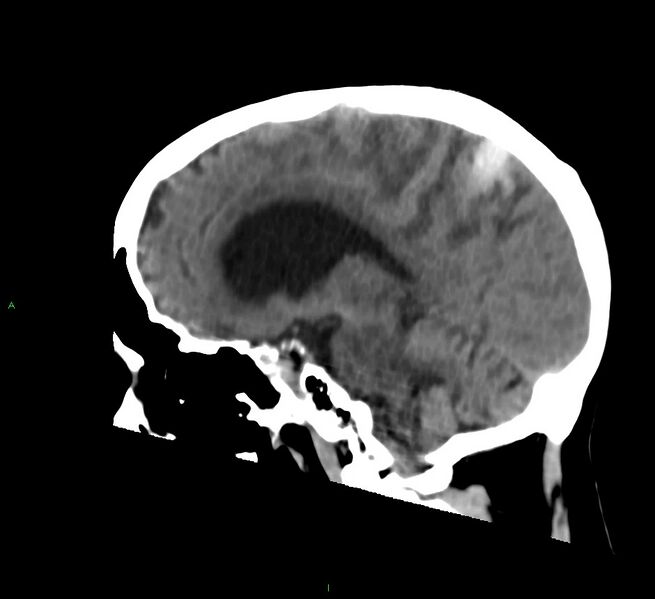 File:Cerebral amyloid angiopathy-associated lobar intracerebral hemorrhage (Radiopaedia 58530-65688 C 31).jpg