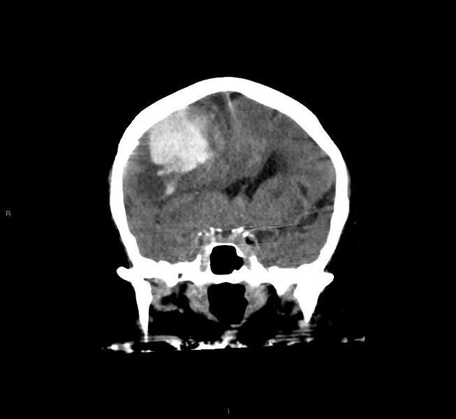 File:Cerebral amyloid angiopathy-associated lobar intracerebral hemorrhage (Radiopaedia 58560-65723 Coronal non-contrast 44).jpg