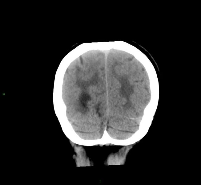 File:Cerebral amyloid angiopathy-associated lobar intracerebral hemorrhage (Radiopaedia 58561-65724 Coronal non-contrast 15).jpg