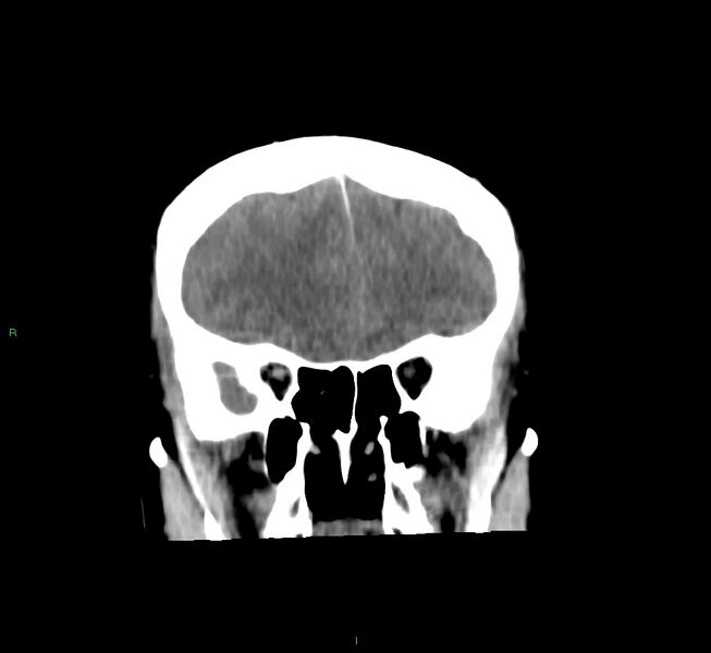 File:Cerebral amyloid angiopathy-associated lobar intracerebral hemorrhage (Radiopaedia 58756-65977 Coronal non-contrast 48).jpg