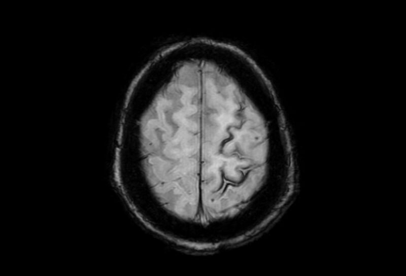 File:Cerebral amyloid angiopathy (Radiopaedia 86671-102792 Axial Gradient Echo 8).jpg