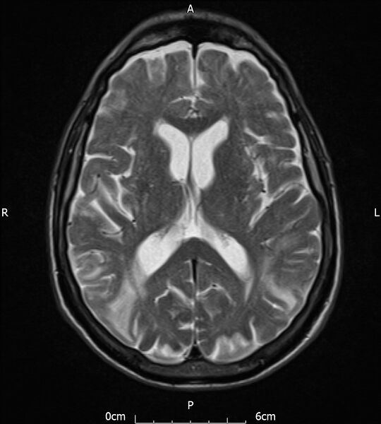 File:Cerebral amyloid angiopathy related inflammation (Radiopaedia 72772-83415 Axial T2 13).jpg
