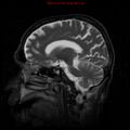 Cerebral and orbital tuberculomas (Radiopaedia 13308-13311 Sagittal T2 8).jpg