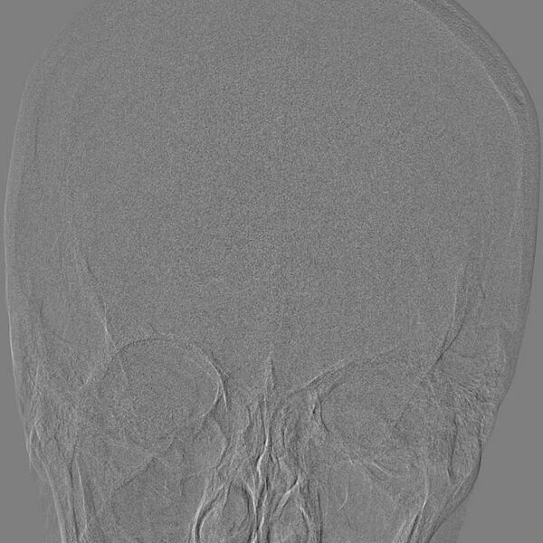 File:Cerebral aneurysm with rupture (Radiopaedia 29933-30458 LT ICA IC 2).jpg