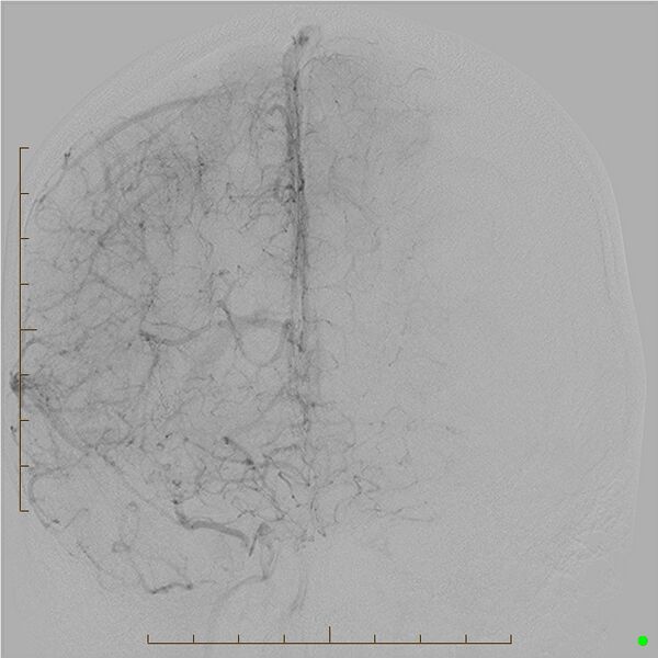 File:Cerebral arteriovenous malformation (AVM) (Radiopaedia 78162-90707 A 16).jpg
