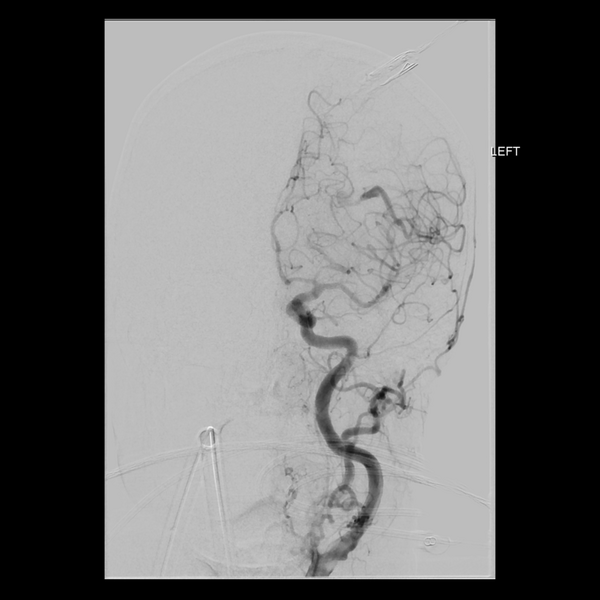 File:Cerebral arteriovenous malformation with lobar hemorrhage (Radiopaedia 44725-48513 LT CCA IC 13).png