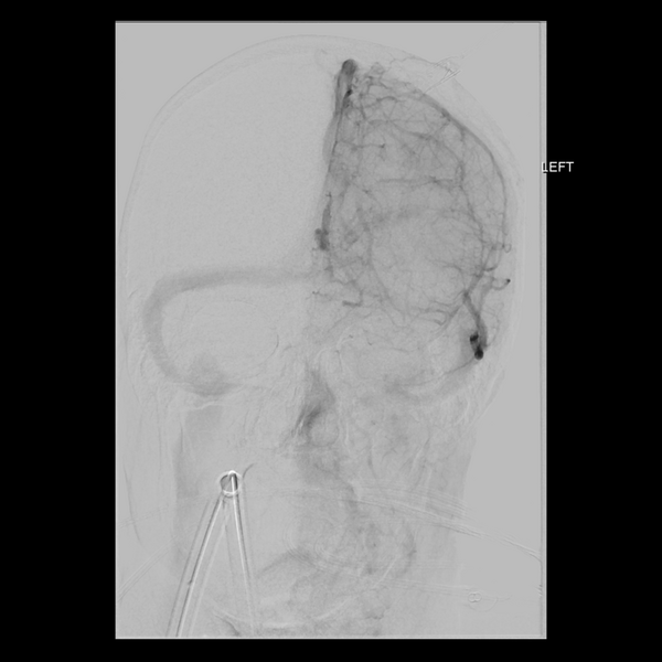 File:Cerebral arteriovenous malformation with lobar hemorrhage (Radiopaedia 44725-48513 LT CCA IC 19).png