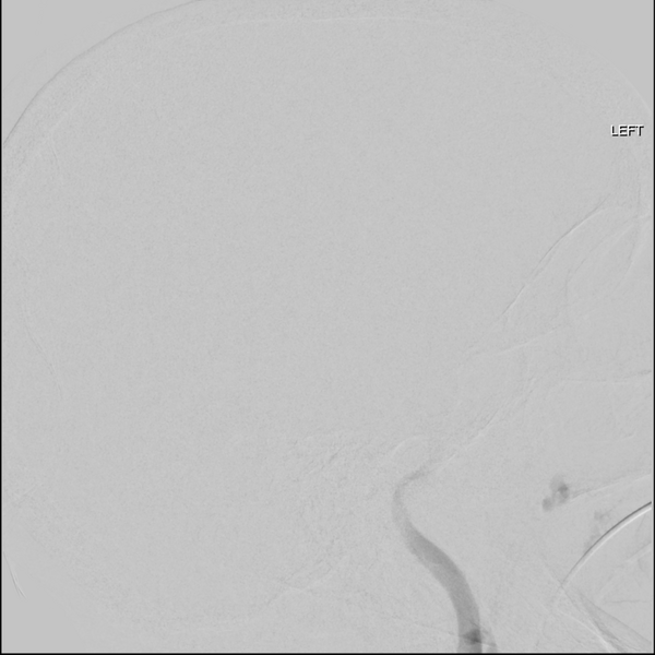 File:Cerebral arteriovenous malformation with lobar hemorrhage (Radiopaedia 44725-48513 LT CCA IC 30).png