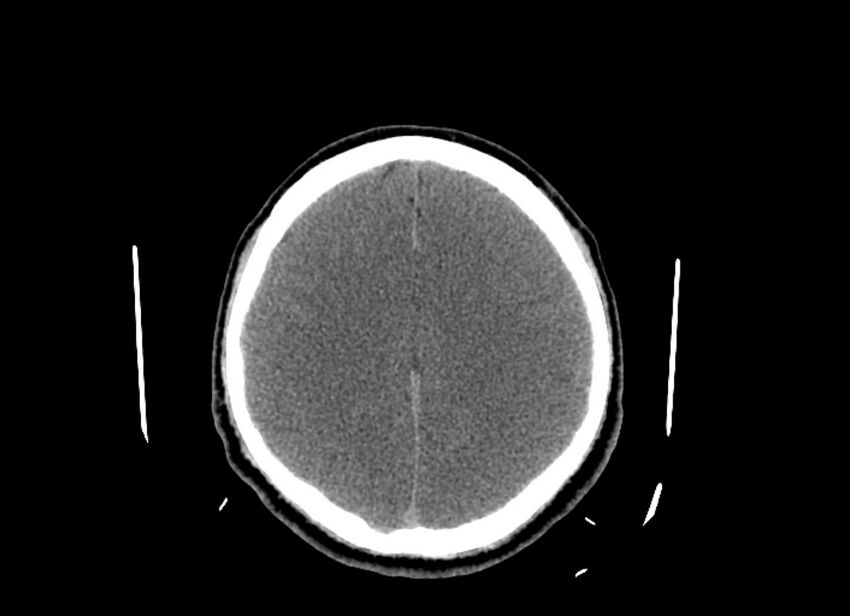 Cerebral edema (Radiopaedia 82519-96661 Axial non-contrast 19).jpg