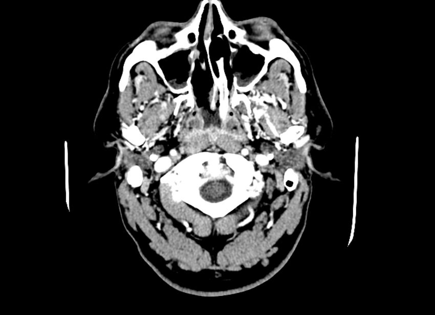 Cerebral edema (Radiopaedia 82519-96661 B 56).jpg