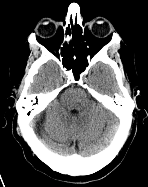 File:Cerebral embolic infarcts (embolic shower) (Radiopaedia 57395-64341 Axial non-contrast 10).png