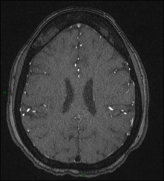 File:Cerebral fat embolism (Radiopaedia 35022-36525 Axial TOF 136).jpg