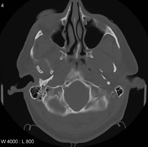 File:Cerebral hemorrhagic contusion with subdural and subarachnoid hemorrhage (Radiopaedia 10680-11146 Axial bone window 4).jpg
