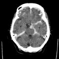 Cerebral hemorrhagic contusions (Radiopaedia 23145-23188 Axial non-contrast 12).jpg