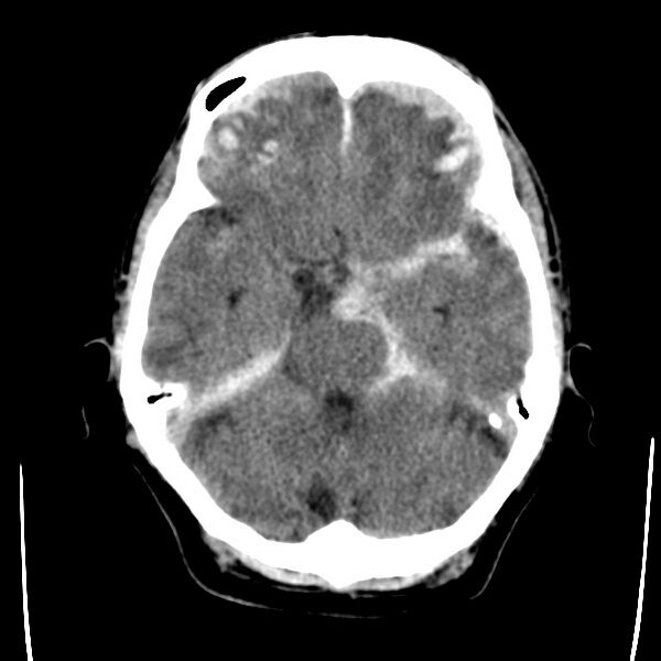 File:Cerebral hemorrhagic contusions (Radiopaedia 23145-23188 Axial non-contrast 12).jpg