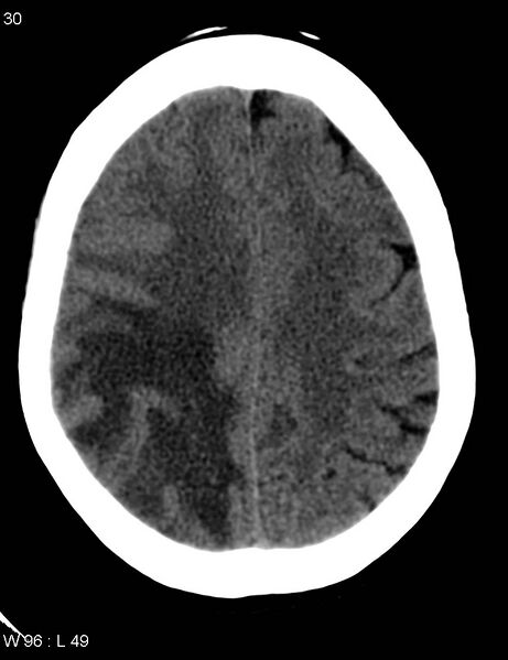 File:Cerebral metastasis - lung cancer (Radiopaedia 5315-7072 Axial non-contrast 9).jpg