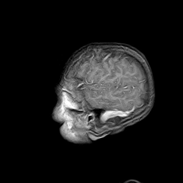 File:Cerebral tuberculoma (Radiopaedia 41152-43932 Sagittal T1 C+ 2).jpg