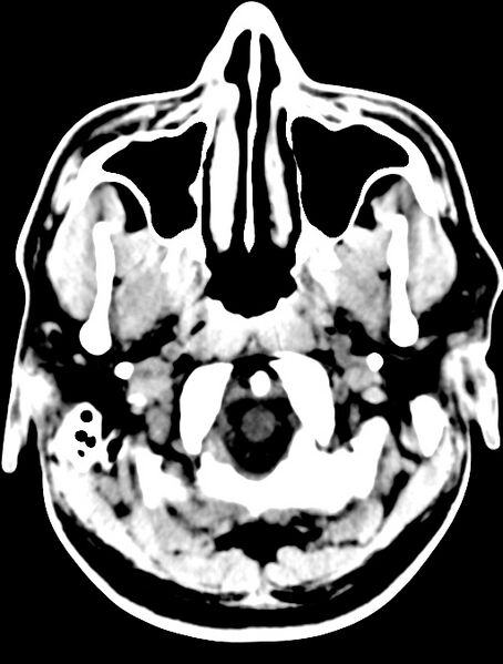 File:Cerebral venous angioma (Radiopaedia 69959-79977 Axial non-contrast 4).jpg