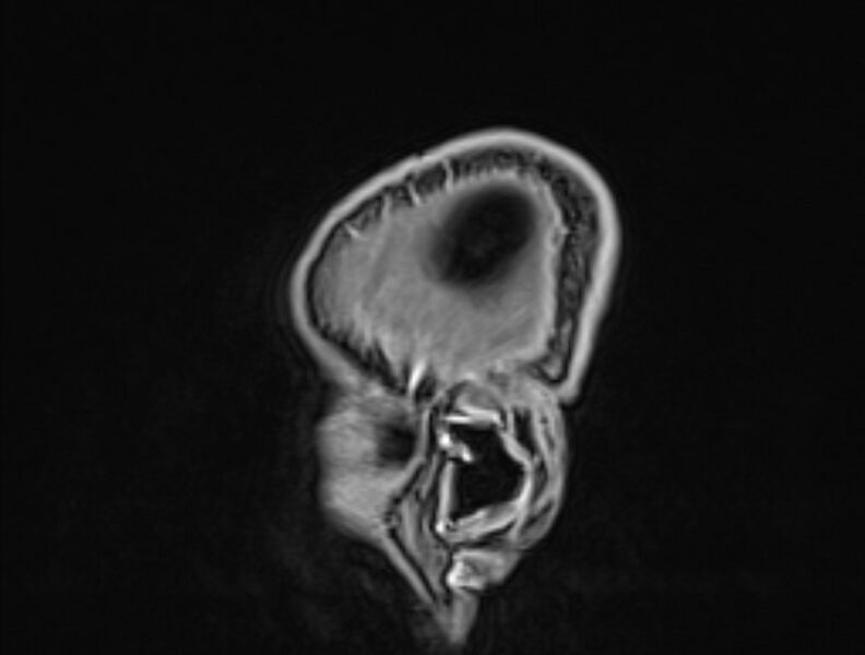 File:Cerebral venous thrombosis (Radiopaedia 71207-81504 Sagittal T1 C+ 64).jpg