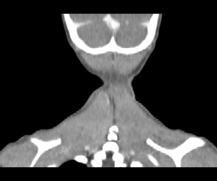 File:Cervical cystic lymphangioma (Radiopaedia 63655-72332 Coronal + contrast 32).jpg