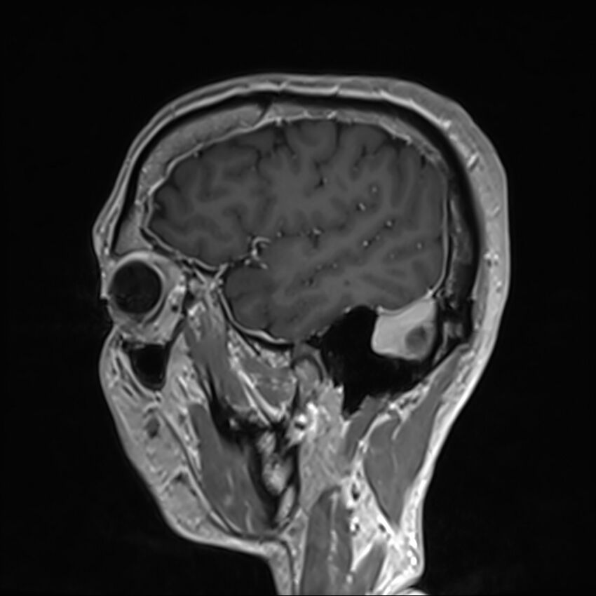 Cervical dural CSF leak on MRI and CT treated by blood patch (Radiopaedia 49748-54995 G 10).jpg