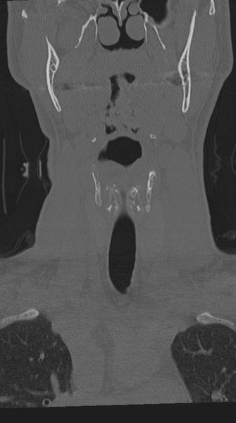 File:Cervical intercalary bone (Radiopaedia 35211-36748 Coronal bone window 15).png