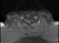 Cervical schwannoma (Radiopaedia 72399-82934 Axial T1 C+ fat sat 15).jpg