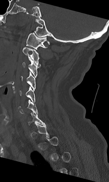 File:Cervical spine fracture - chalk stick (Radiopaedia 39116-41323 Sagittal bone window 40).png