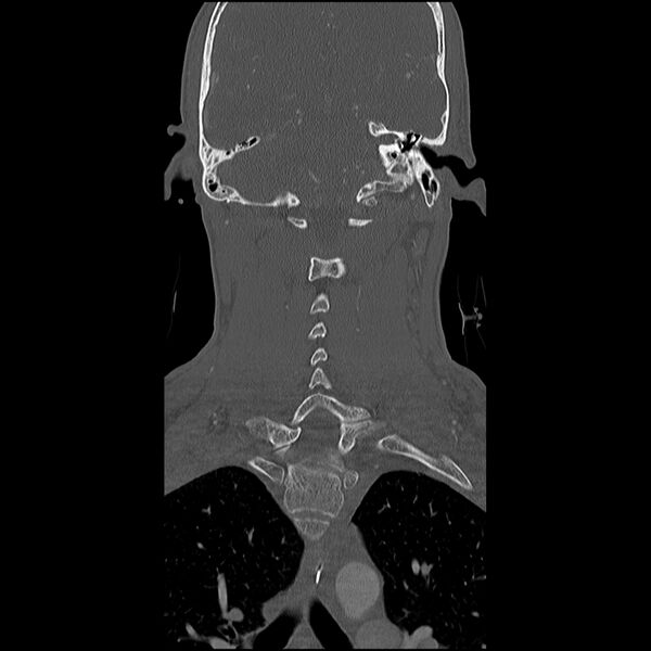 File:Cervical spine fractures with vertebral artery dissection (Radiopaedia 32135-33078 Coronal bone window 21).jpg