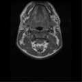 Cervical vertebrae metastasis (Radiopaedia 78814-91667 Axial T1 4).png