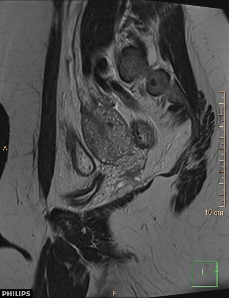 File:Cesarian scar endometriosis (Radiopaedia 68495-78066 Sagittal T2 20).jpg