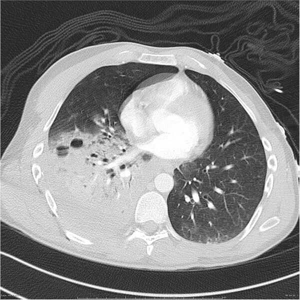 File:Chest and abdomen multi-trauma (Radiopaedia 26294-26425 lung window 66).jpg