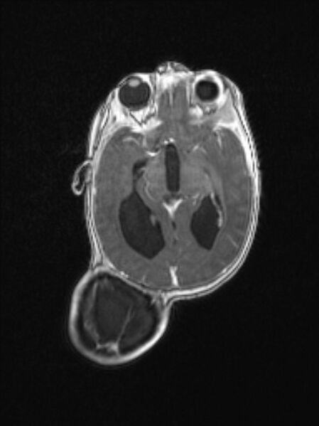 File:Chiari III malformation with occipital encephalocele (Radiopaedia 79446-92559 Axial T1 C+ mpr 46).jpg