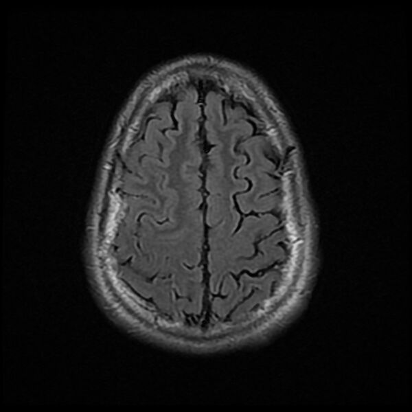 File:Chiasmatic-hypothalamic juvenile pilocytic astrocytoma (Radiopaedia 78533-91235 Axial FLAIR 23).jpg