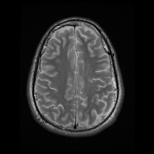 File:Chiasmatic-hypothalamic juvenile pilocytic astrocytoma (Radiopaedia 78533-91235 Axial T2 21).jpg