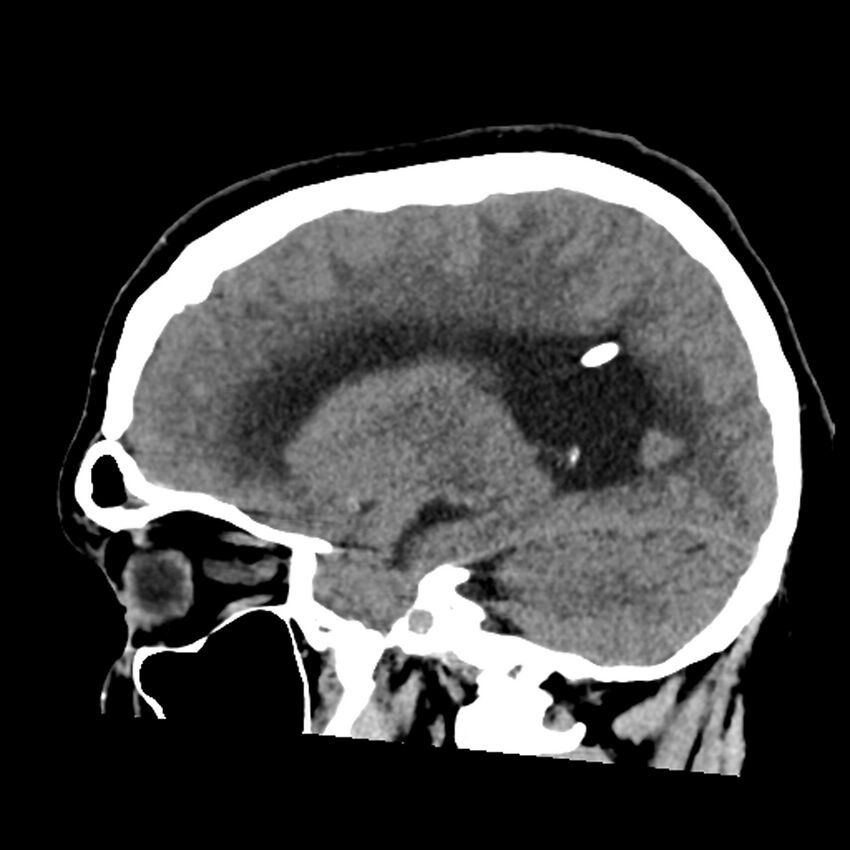 Chiasmatic-hypothalamic juvenile pilocytic astrocytoma (Radiopaedia 78533-91237 B 41).jpg