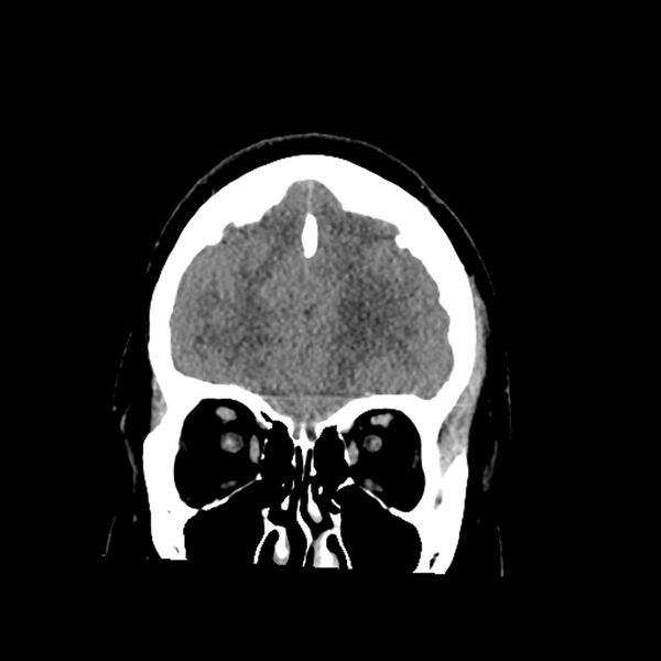 File:Chiasmatic-hypothalamic juvenile pilocytic astrocytoma (Radiopaedia 78533-91237 Coronal non-contrast 17).jpg