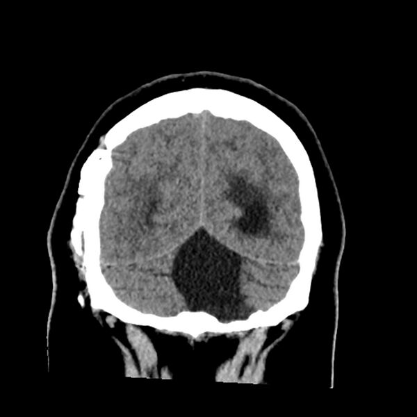 File:Chiasmatic-hypothalamic juvenile pilocytic astrocytoma (Radiopaedia 78533-91237 Coronal non-contrast 58).jpg