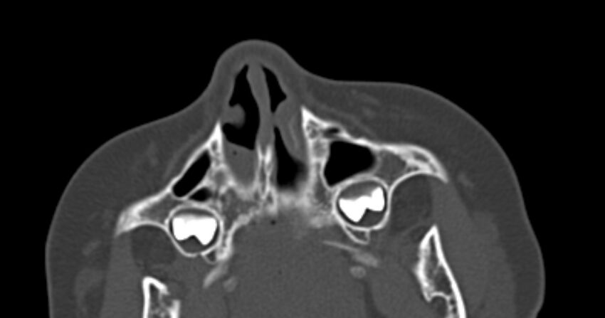 Choanal atresia (Radiopaedia 51295-56972 Axial bone window 10).jpg