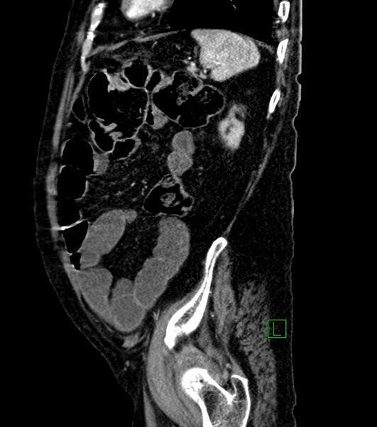 File:Cholangiocarcinoma with cerebral metastases (Radiopaedia 83519-98629 F 30).jpg