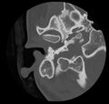 Cholesteatoma (Radiopaedia 20296-20217 bone window 12).jpg